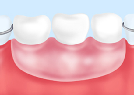 義歯・インプラント・ブリッジそれぞれの特徴を比較