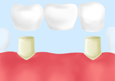 義歯・インプラント・ブリッジそれぞれの特徴を比較