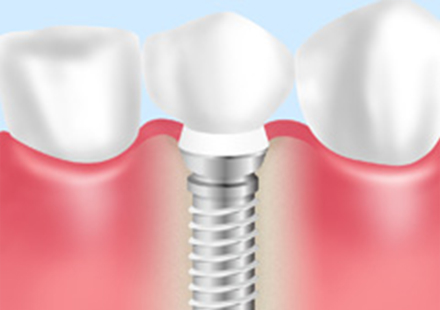 義歯・インプラント・ブリッジそれぞれの特徴を比較