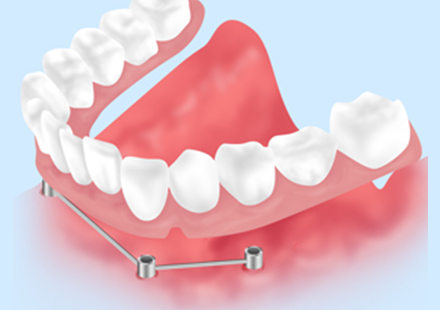 しっかり噛めるインプラントオーバーデンチャー