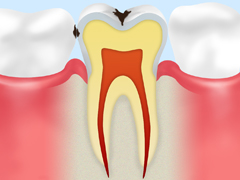 虫歯の初期（C1）