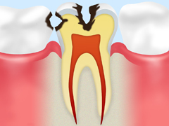 虫歯の中期(C2)