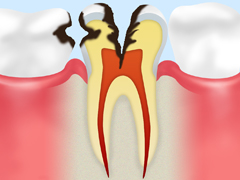 虫歯の後期(C3)