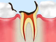 虫歯の末期(C4)